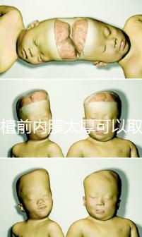 移植前內(nèi)膜太厚可以取卵早知道,疼痛因人而異