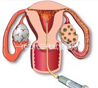 一代二代三代試管嬰兒有什么區別?