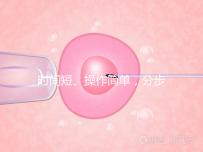 時間短、操作簡單，分步驟解讀宮頸擴張術全過程