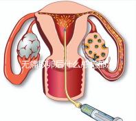 無痛取卵后什么感覺都沒有異常是謠言！只會出現一部分...