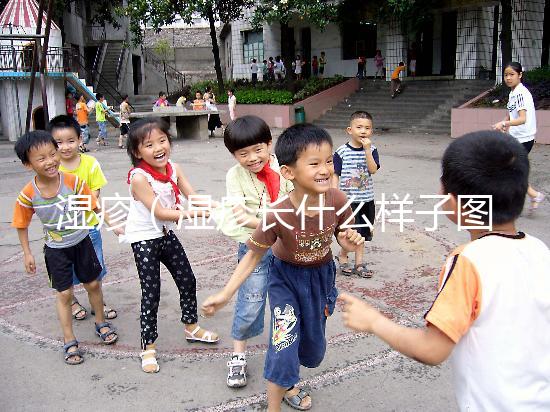 濕疹(濕疹長(zhǎng)什么樣子圖片)