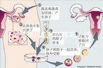 試管嬰兒取卵時(shí)疼嗎(試管嬰兒取卵時(shí)疼嗎,取卵多長(zhǎng)時(shí)間才是移植)